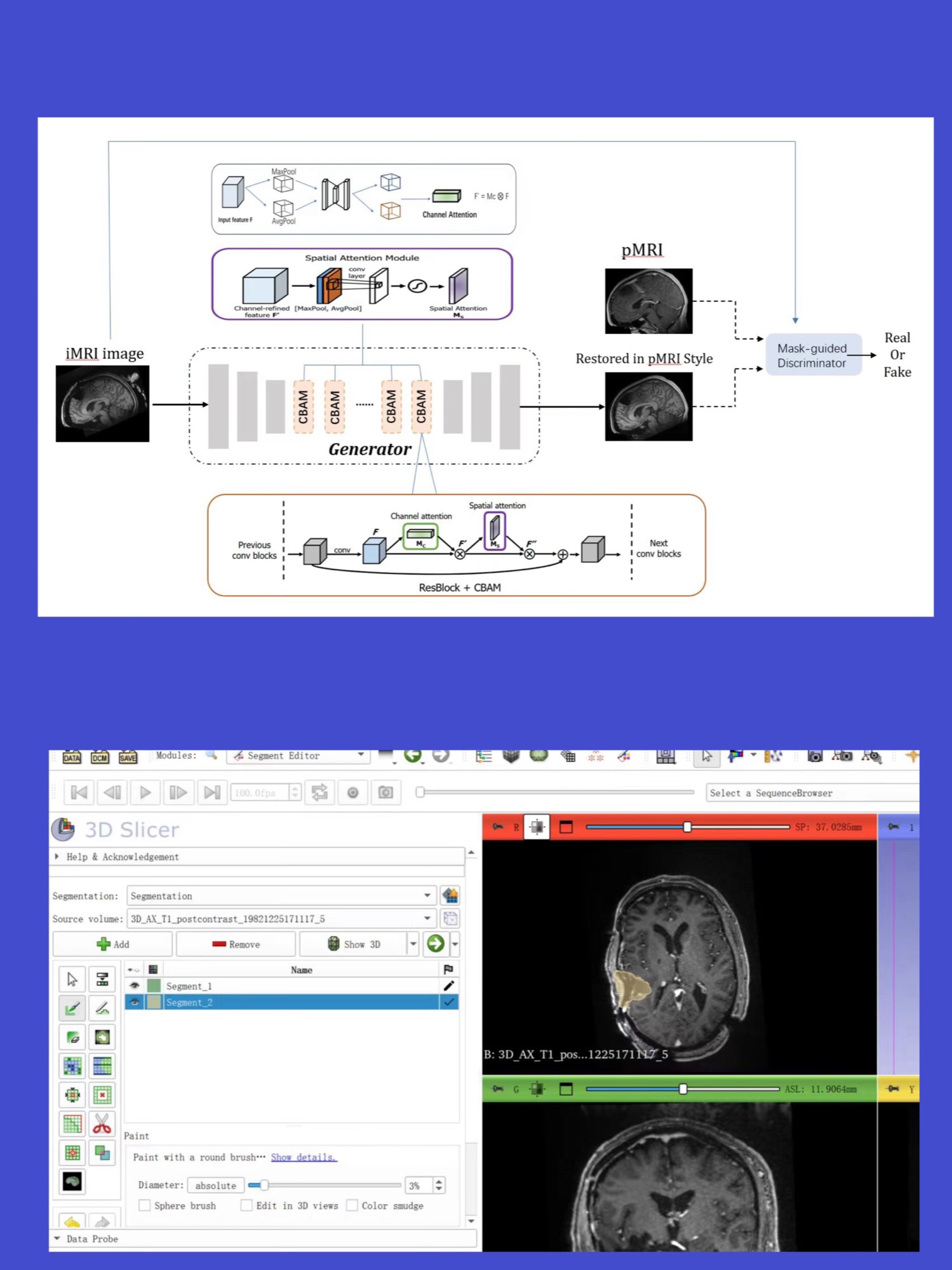 MRI restoration model architecture and brain image segmentation work in 3D Slicer